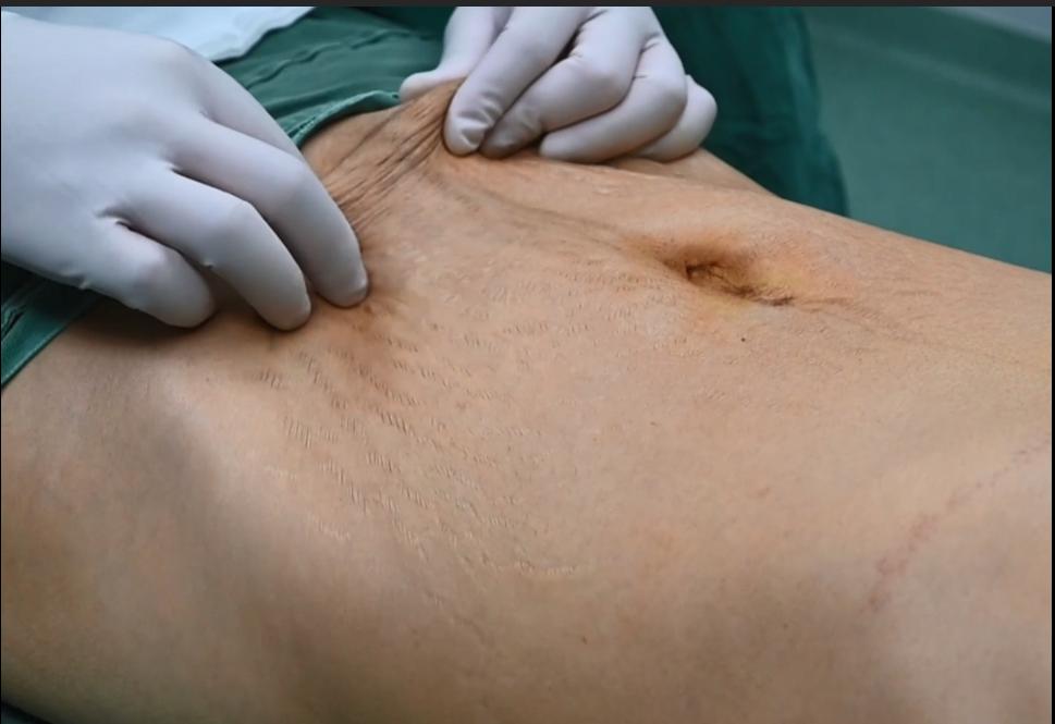 产后腹肉松垮,产后肚皮松像口袋一样