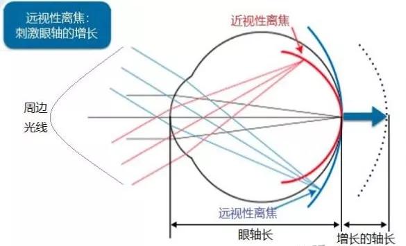 角膜塑形镜控制度数的原理是什么,角膜塑形镜控制近视度数增长