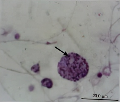 uu感染是什么意思,uu感染严重吗