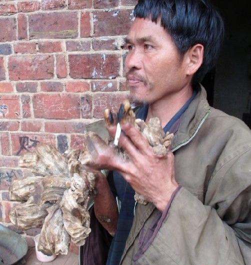 男子手长满树疙瘩是什么病,男子手长满树疙瘩手术了吗