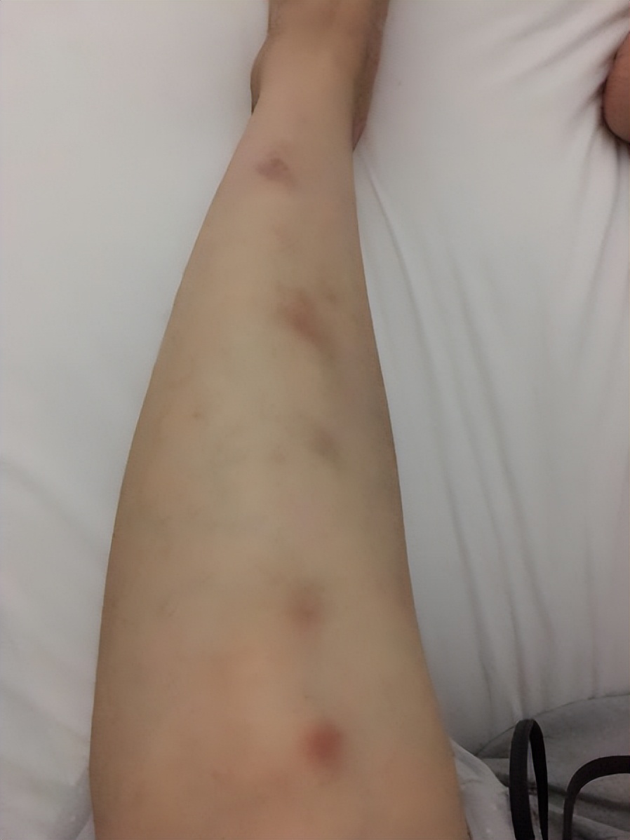 紫癜初期小血点图片,过敏性紫癜中药好还是西药好