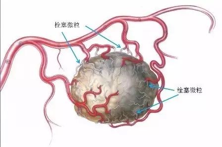 介入科治疗肿瘤最新方法,肿瘤介入治疗堵塞肿瘤血管
