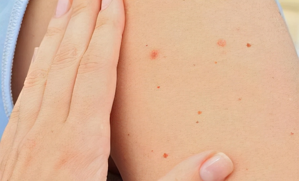 皮肤出现小红点像血点是怎么回事,皮肤上出现了小红点是什么症状