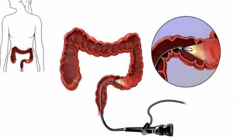 肠道多发息肉还是单发息肉严重,肠道扁平息肉厉害还是息肉厉害