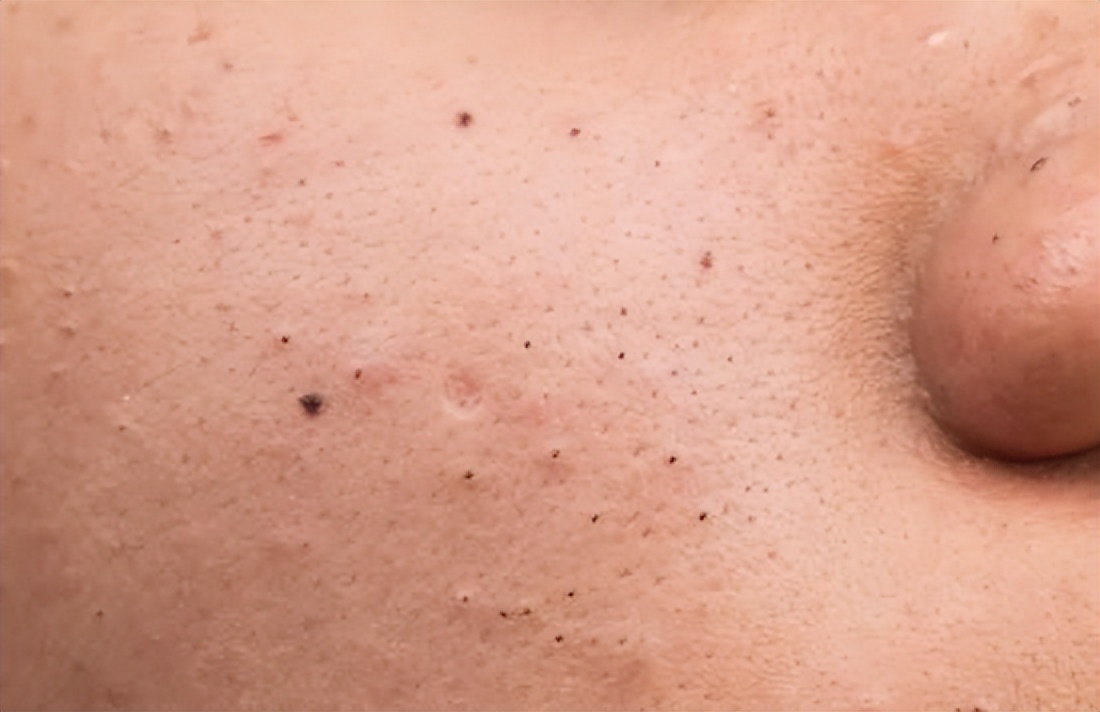 脸上痘痘里面有白米粒是什么原因,脸上频繁长脓包痘痘是什么原因