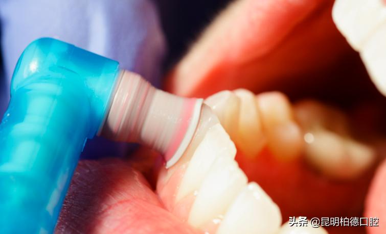 洗牙里面喷砂和抛光有什么区别,洗牙抛光和喷砂抛光的区别