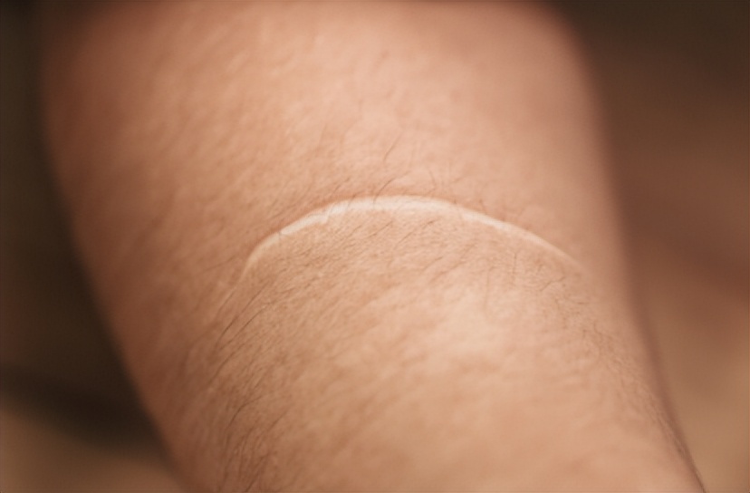 疤痕体质人群应如何预防,怎样才能治疤痕体质