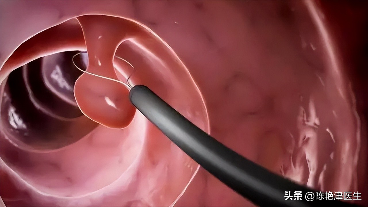 为什么不愿意做肠镜,为啥很多人不愿做肠镜检查