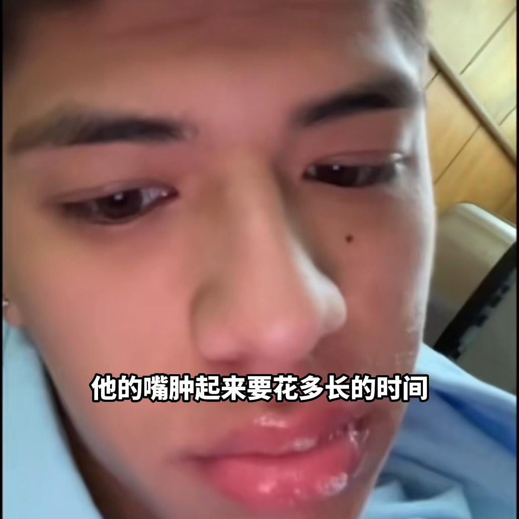 黄蜂蛰了嘴唇为啥越变越大,被黄蜂蛰到嘴唇怎么办