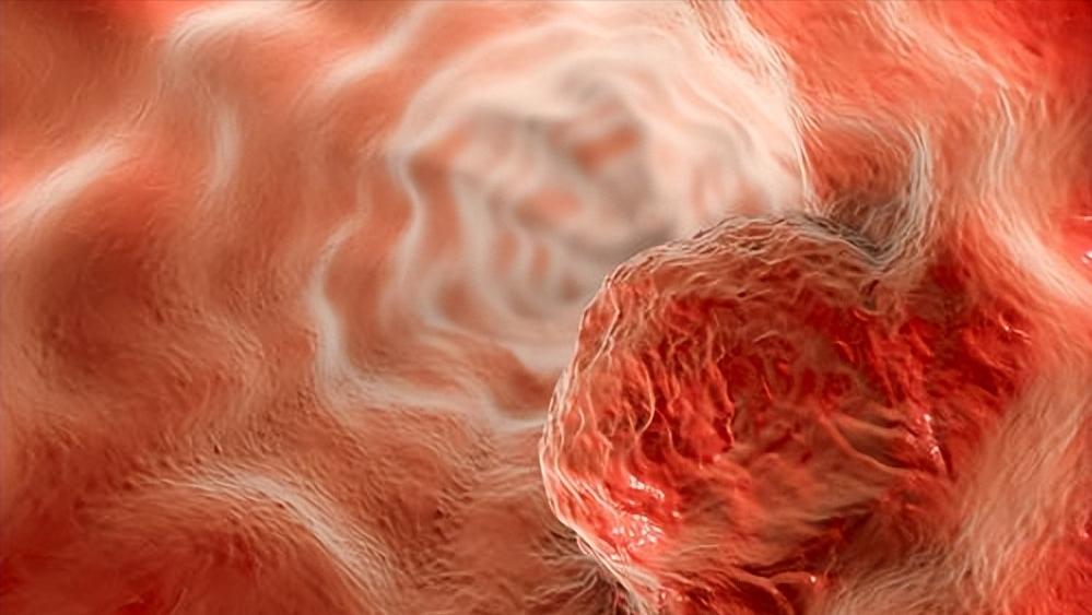 平滑肌瘤和平滑肌肉瘤是一样吗,平滑肌瘤和平滑肌肉瘤的区别