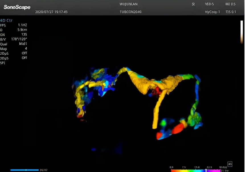延大附院无痛输卵管四维超声造影为患者带来福音
