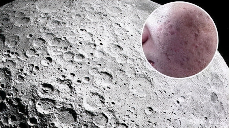 痘印开始变成痘坑了怎么办,痘印痘坑怎么修复最好的办法