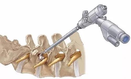 腰椎间盘突出微创术,中央型腰椎间盘突出
