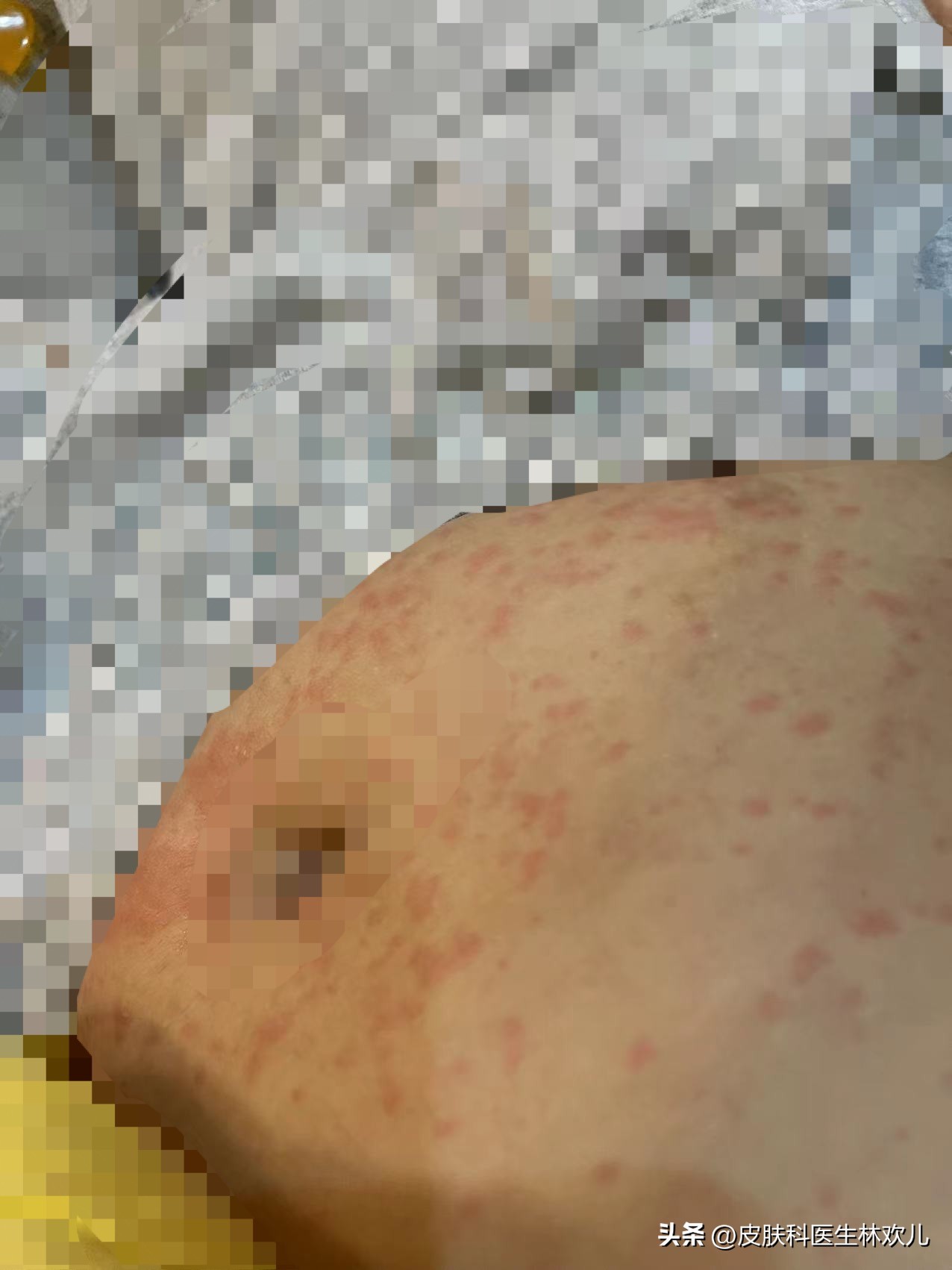 新冠期间皮肤瘙痒红斑咋回事,新冠皮肤痒怎么回事