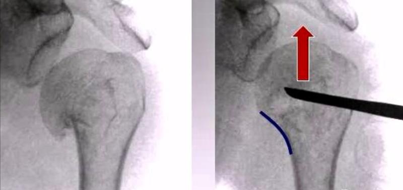 肱骨近端骨折属于几级伤残,肱骨近端骨折康复训练技巧