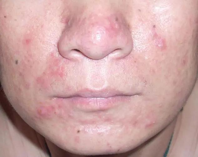 痘痘反复长怎么办皮肤科,痘痘总是反反复复的原因有哪些