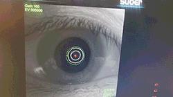 眼轴需要经常检测吗,眼轴测量有可能误测吗