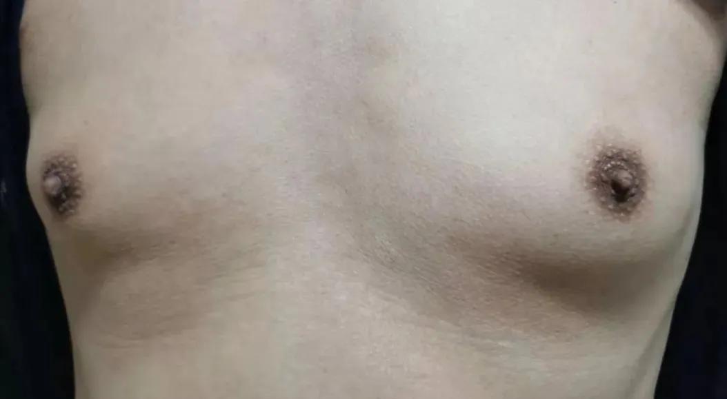 乳腺增生跟有没有男朋友有关系吗,男生乳腺增生可以通过锻炼治愈吗