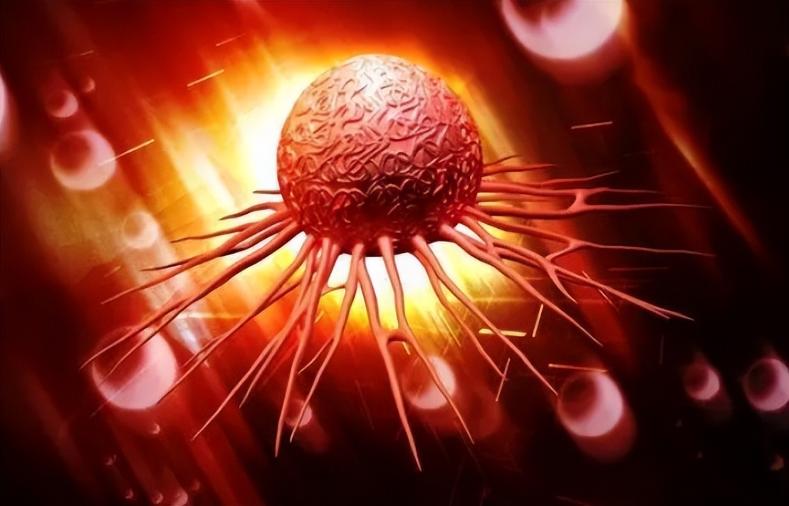 宫颈管内癌前病变,女性内裤有这迹象该留意宫颈癌