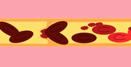 医生科普斑块逆转的关键是什么,逆转斑块最好的方法