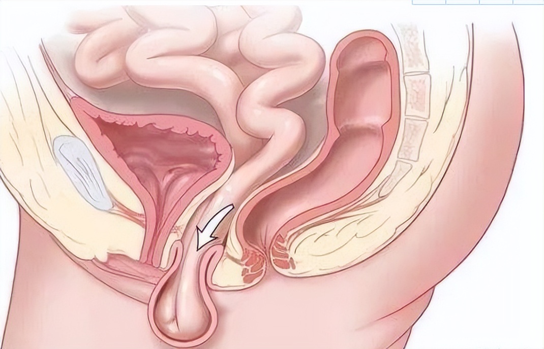 40岁女性漏尿是什么原因,40岁女性偶尔漏尿怎么回事