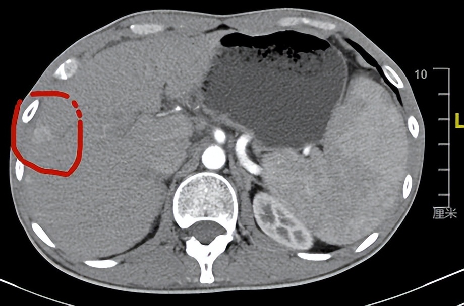 肝癌从1厘米长到10厘米需要多久,肝癌10厘米没有任何症状能活多久