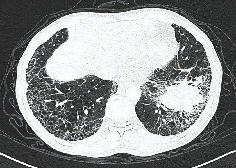 肺间质病变分型及治疗,肺间质疾病是什么意思