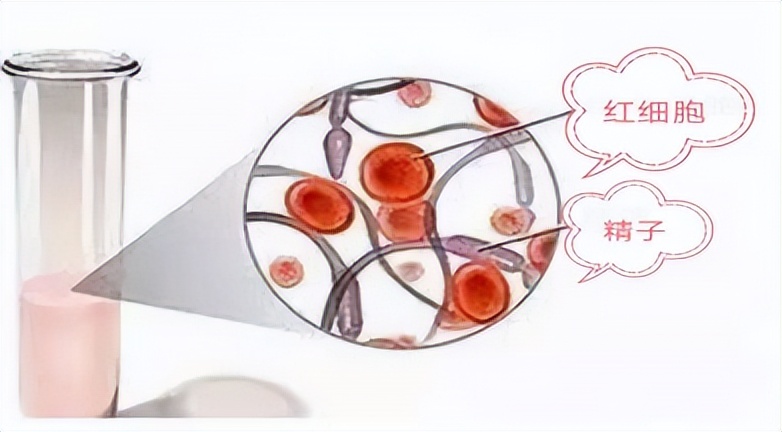 出现血精能自愈吗,出现血精能自愈吗无其他症状