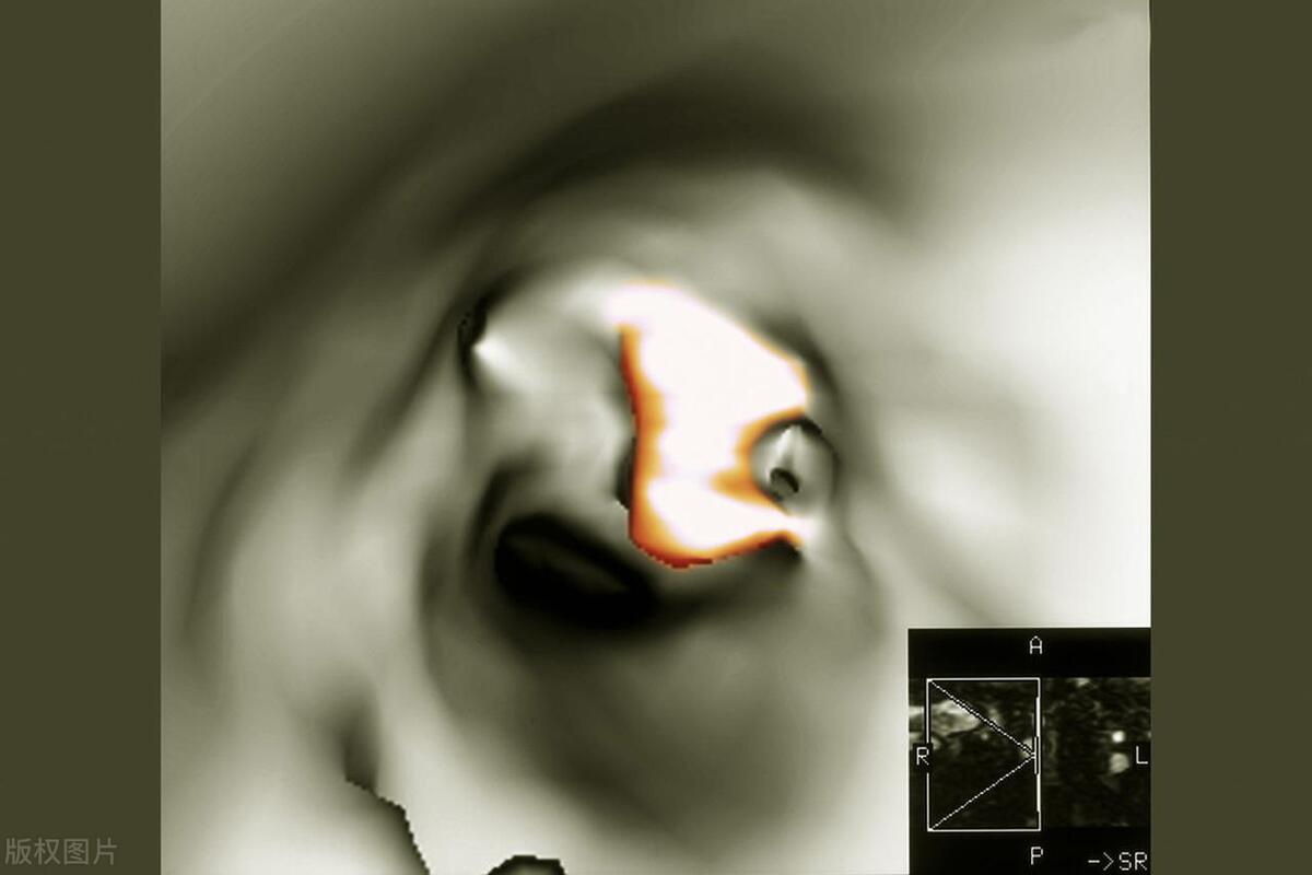 脑梗颈动脉斑块90%能治愈吗,有颈动脉斑块需要服他汀药吗