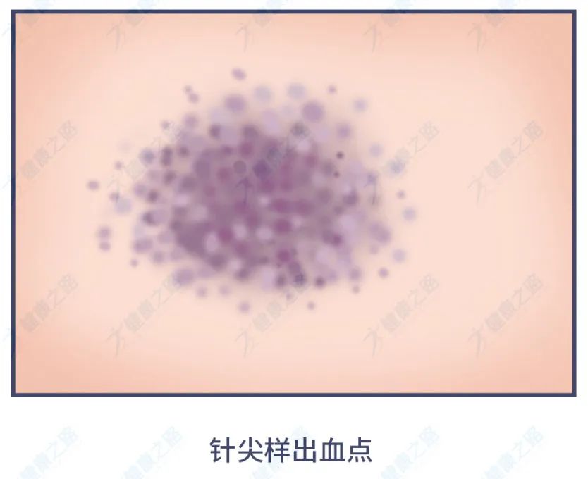 警惕身上出现的小黑痣,警惕皮肤黑痣