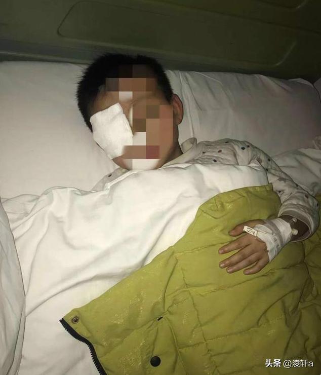 8岁男孩20分钟后眼球融化,男童眼球瞬间被融化