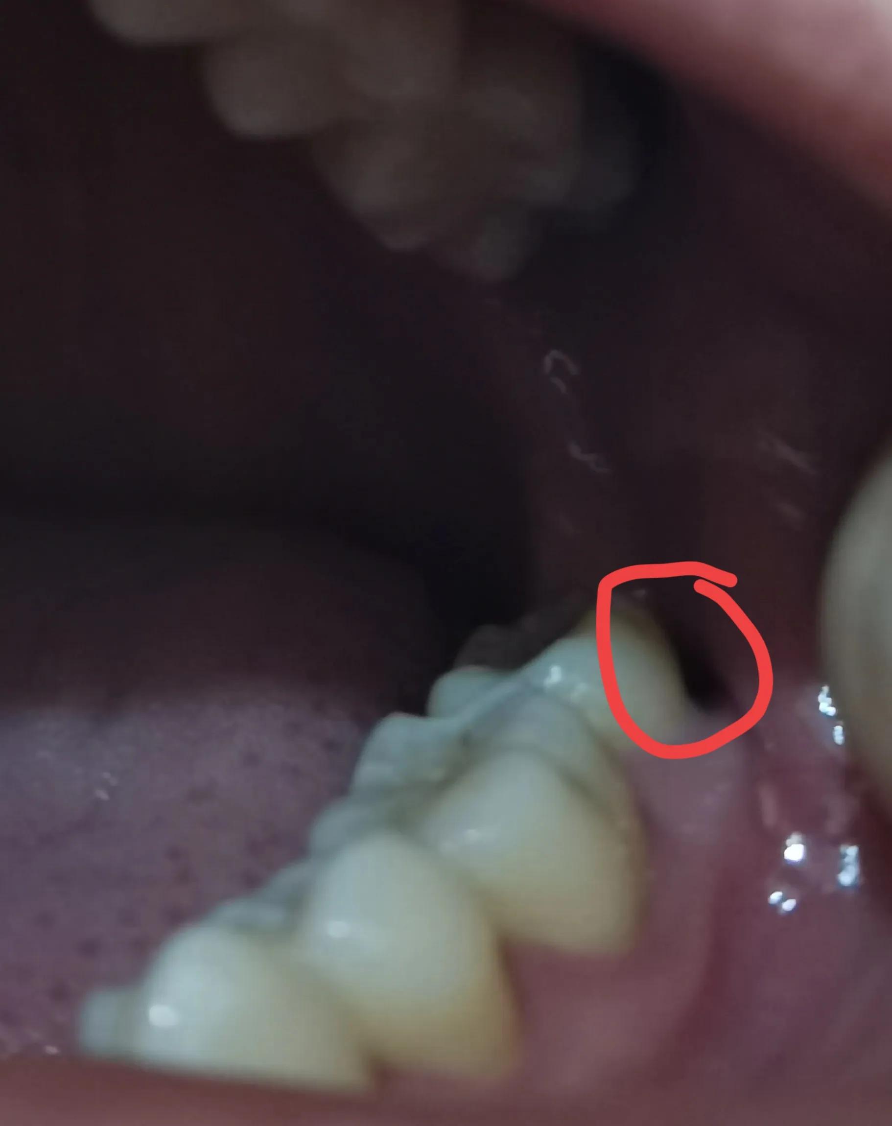 拔完智齿有一个洞怎么处理,拔完智齿没缝有个很大的洞怎么办