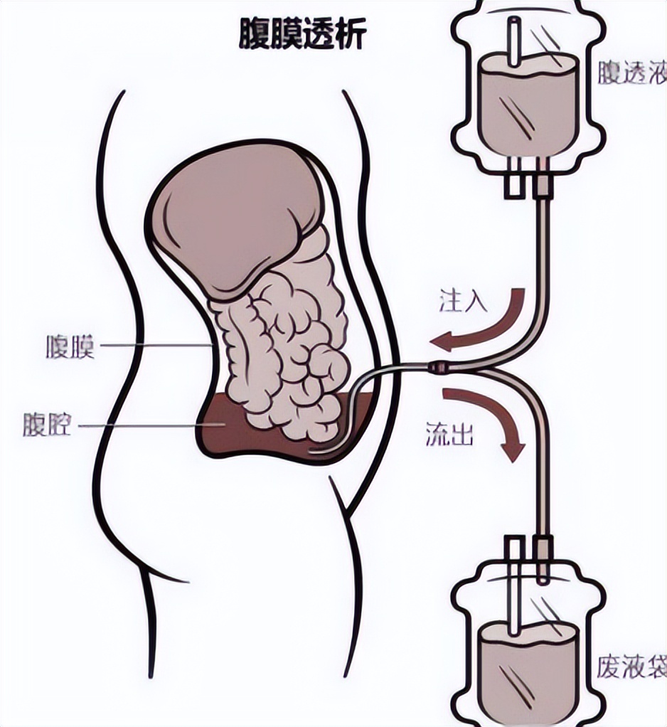 腹膜透析导管相关并发症原因分析,腹膜透析常见问题及解决方法