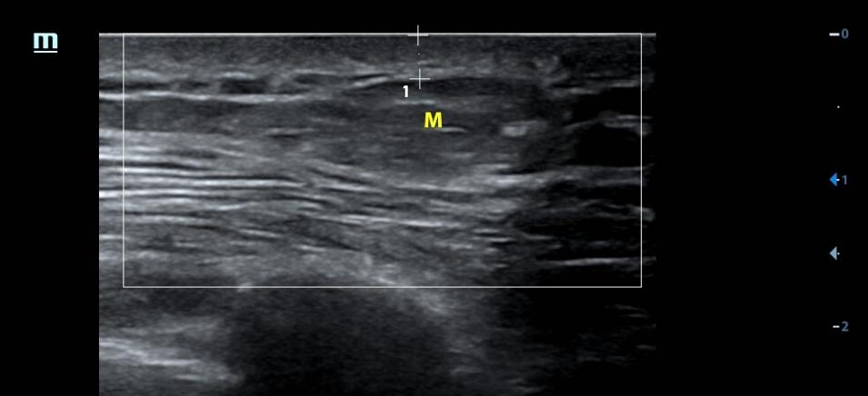 超声介入入门,手把手教你入门超声
