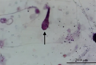 uu感染是什么意思,uu感染严重吗