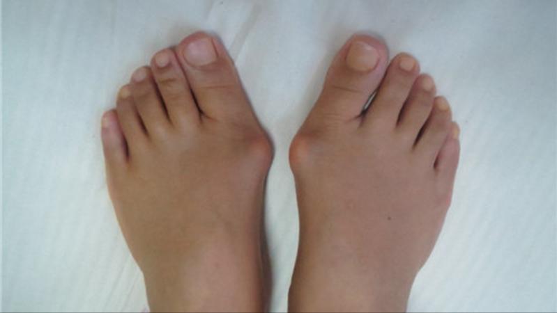 脚底板爱进风什么原因,脚底板走路磨起茧子怎么去