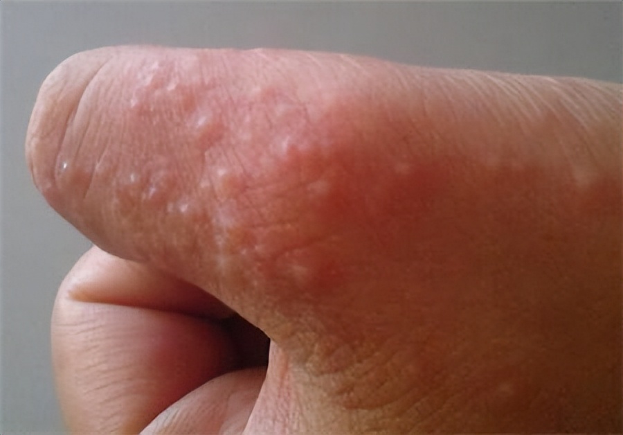 手脱皮如何判断是缺维生素还是癣,手脱皮是不痒是感染了癣吗