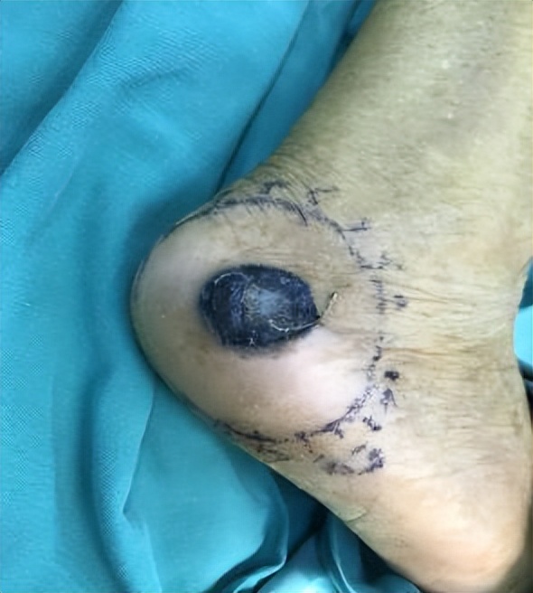 色素痣割了会不会转为黑色素瘤,针眼大的色素痣会癌变么