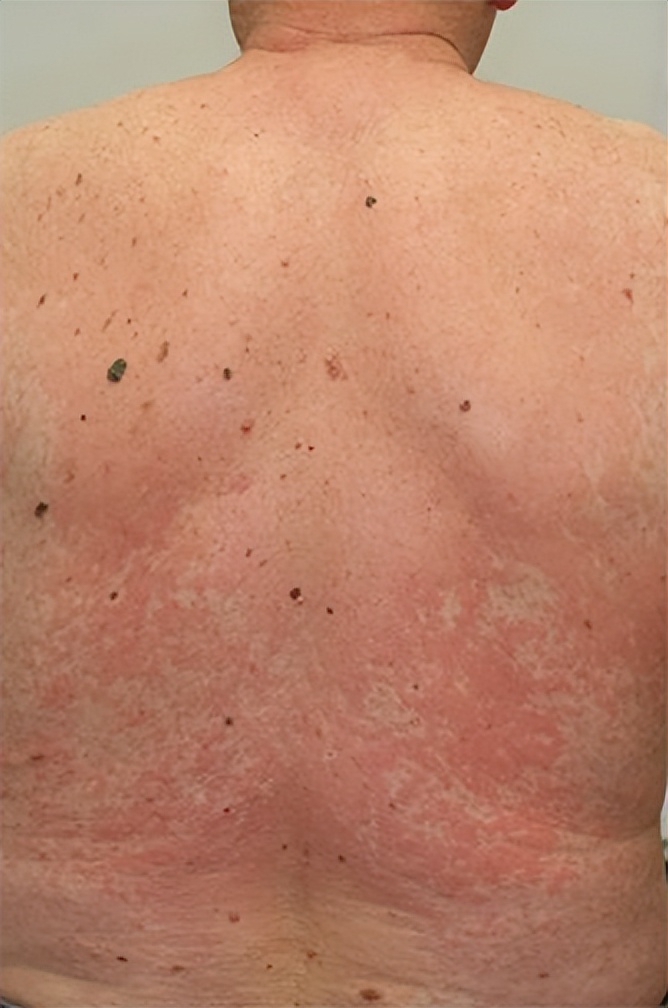 药物反应引起皮肤瘙痒,吃药后皮肤出现药疹