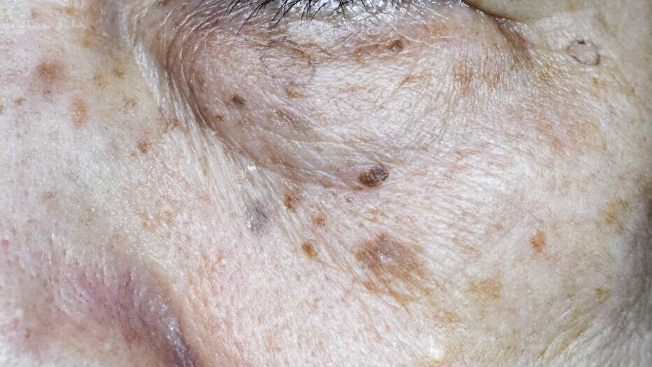 红霉素软膏可以去除老年斑吗,红霉素加阿司匹林老年斑一擦就掉