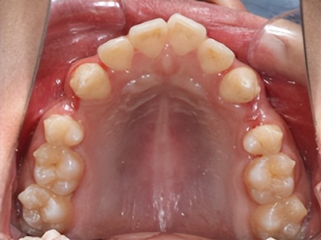拔牙矫正后多长时间能合缝,拔牙矫正需要缝线吗