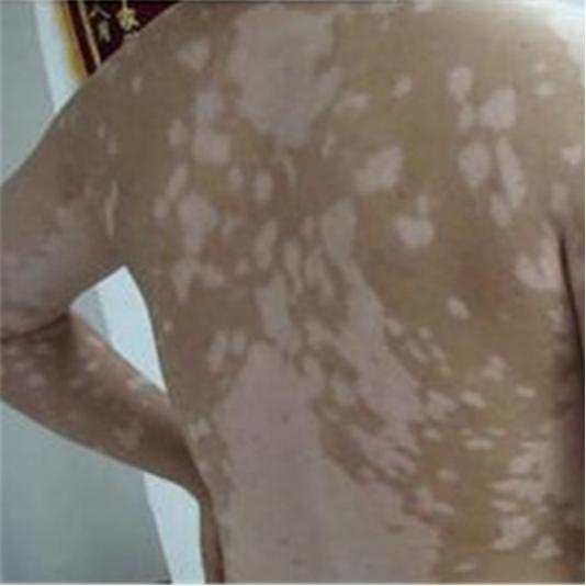 白斑竟然自愈了,白斑还在扩散怎么治