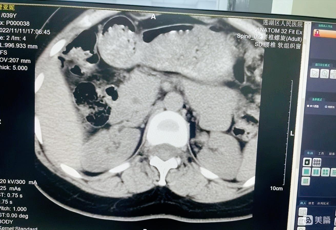 陕西省人民医院ct当天能出结果吗,医院128层螺旋ct多少钱