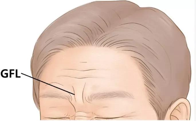 精准注射：如何用更少剂量肉毒毒素处理眉间纹？
