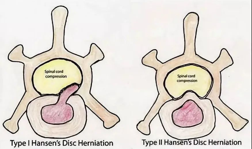 狗狗颈椎椎间盘突出导致前肢瘫痪,狗狗颈椎骨质增生压迫神经怎么办