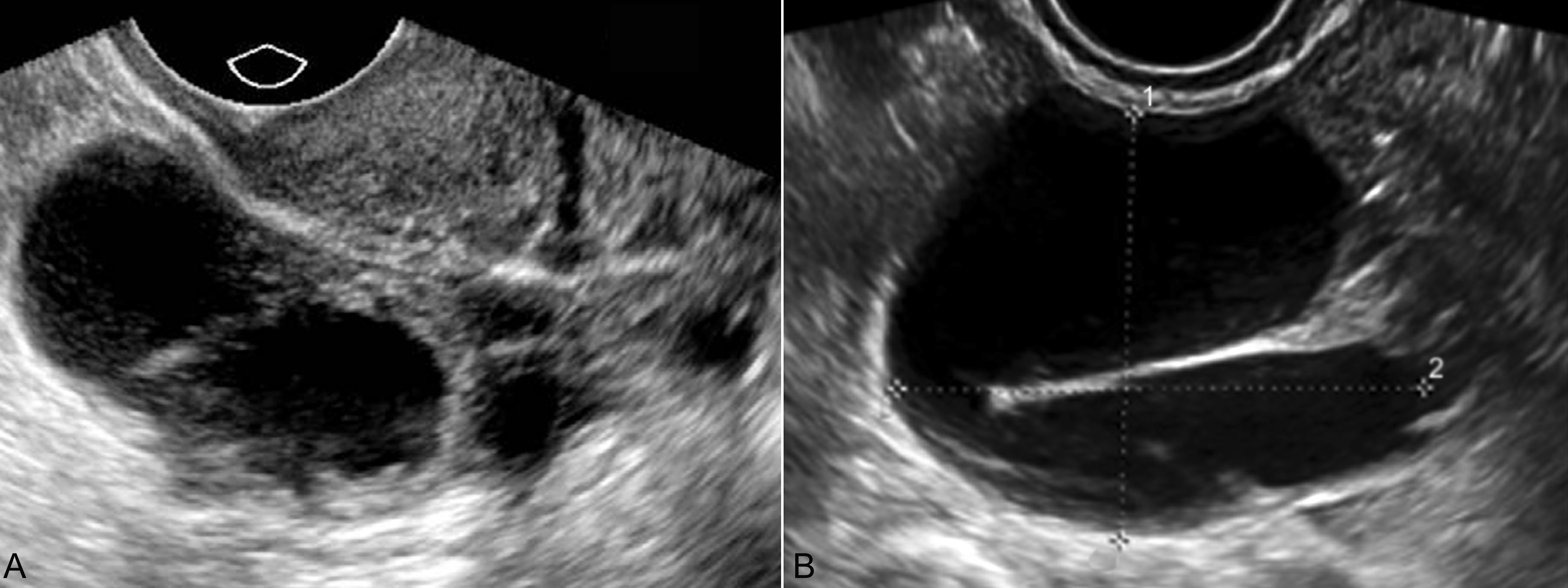 明明白白做超声33-11：妊娠合并盆腔其他异常