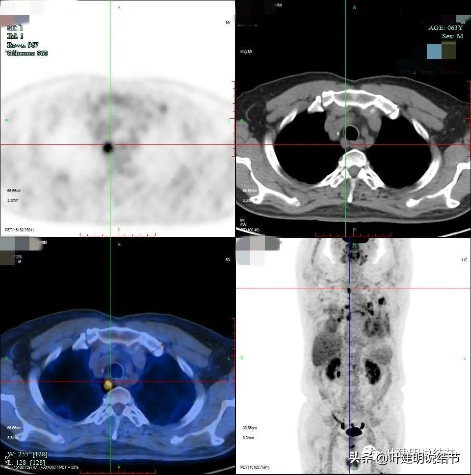 pet判断淋巴结转移,petct判断癌有没有转移准确吗