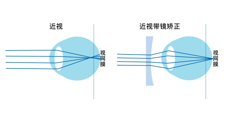 视力1.75还能恢复吗,视力1.75近视算严重吗