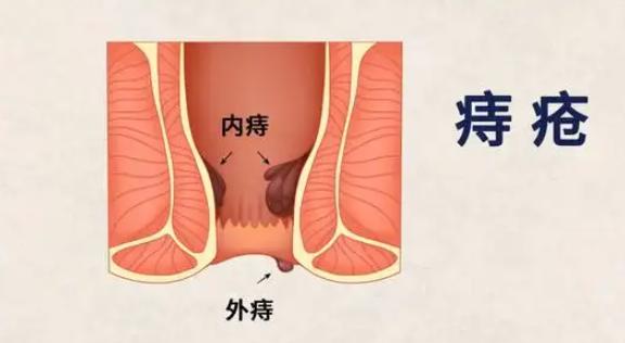 混合痔疮手术后有复发的可能性吗,痔疮传统外剥内扎手术容易复发吗