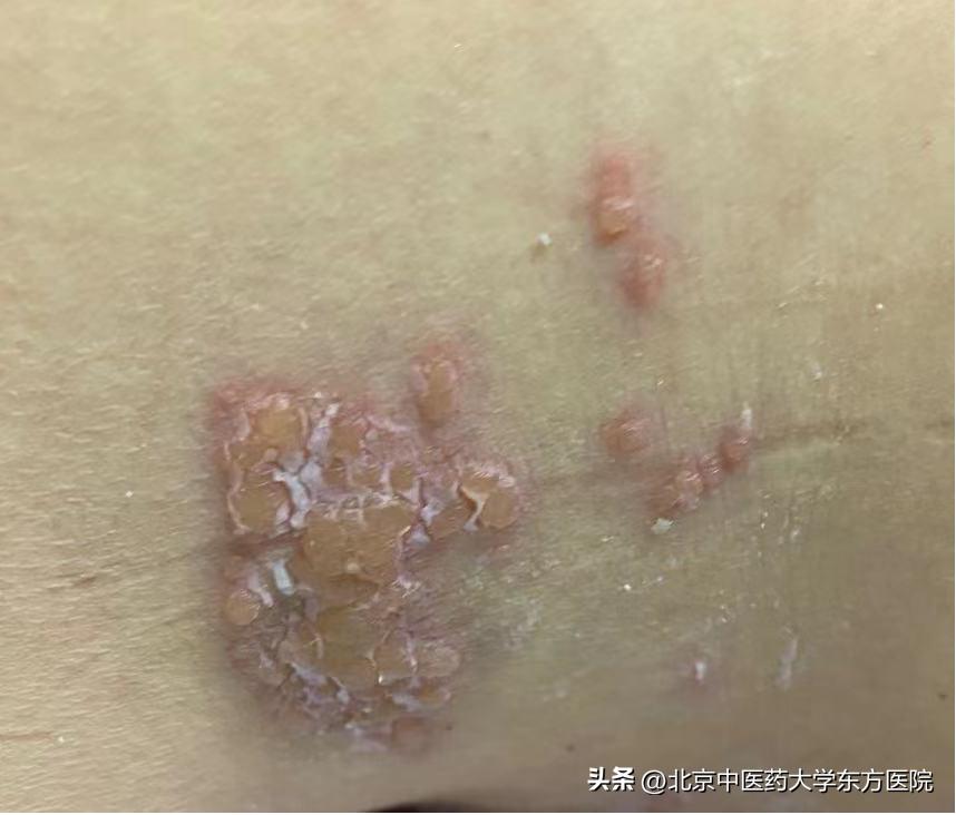 带状疱疹的疼痛和出疹有关联吗,带状疱疹神经痛会越来越痛吗